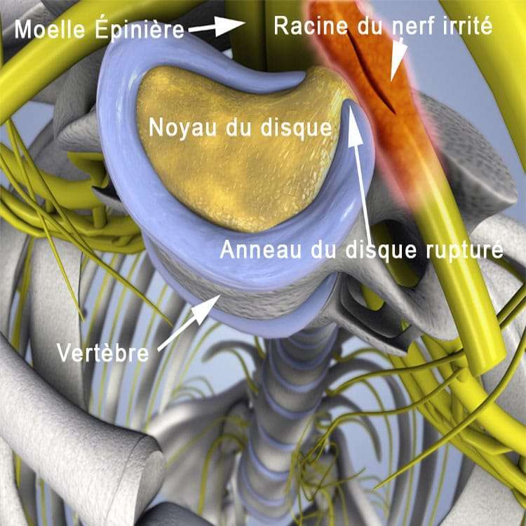 Décompression Neurovertébrale Clinique Tagmed Montréal Terrebonne