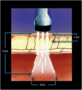 Traitement Du Syndrome Du Tunnel Carpien Clinique Tagmed Montréal Terrebonne