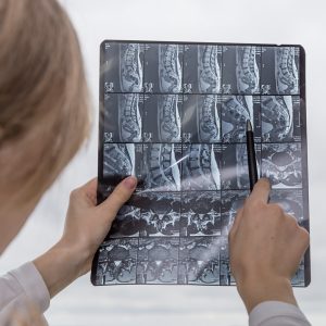 Sténose Spinale Clinique Tagmed Montréal Terrebonne Sténose Spinale Clinique Tagmed Montréal Terrebonne